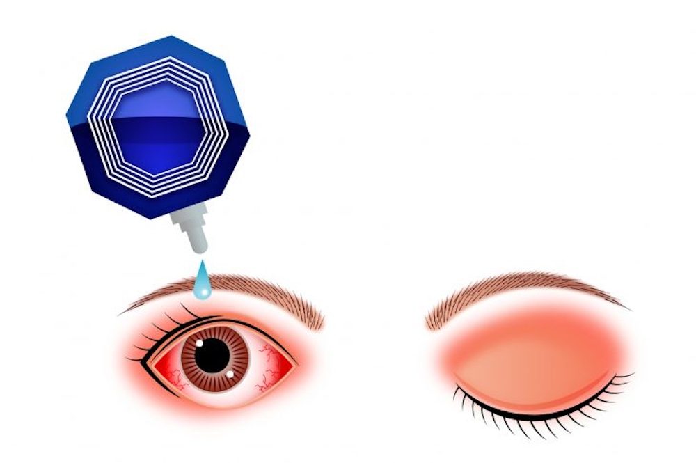 近年増えているドライアイの特徴と対策について